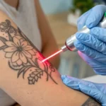 Comparison of laser tattoo removal and AI skin regeneration on a patient's arm, showcasing medical technology advancements.
