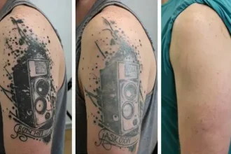 Tattoo removal picture showing 3 stages of tattoo removal process and timeline