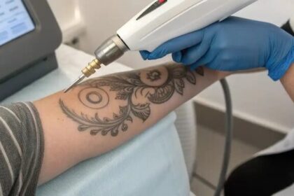 A realistic image of a patient receiving PicoSure laser treatment—the fastest tattoo removal method—showing minimal skin irritation and rapid fading.
